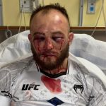 UFC star is horrifically disfigured as he shares pic of face injuries from hospital after 16-fight winning streak ends